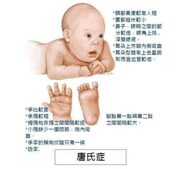 唐氏综合症