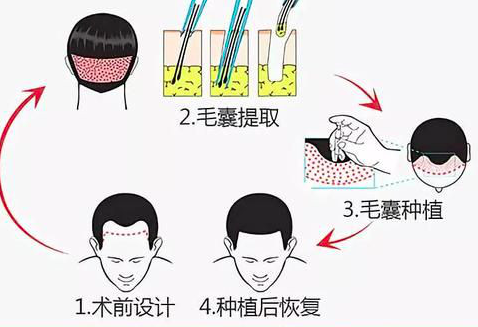 毛囊单位提取