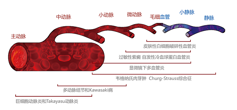 血管炎