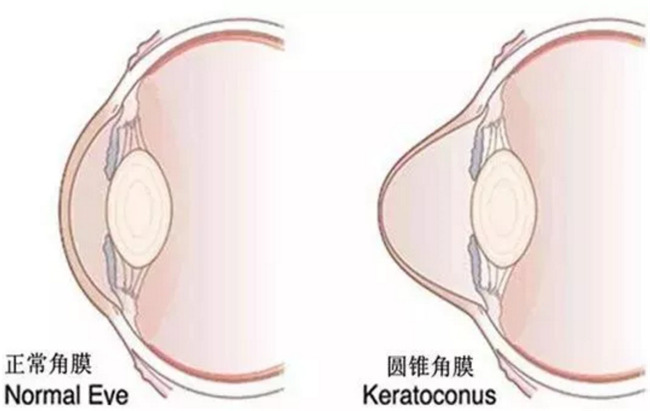 圆锥角膜