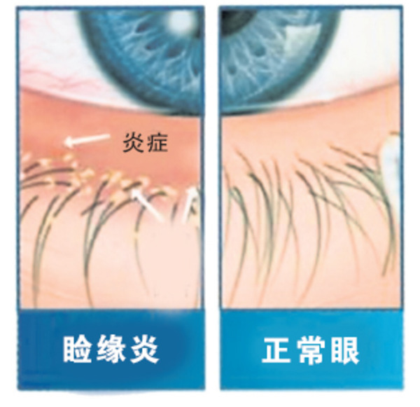 睑缘炎