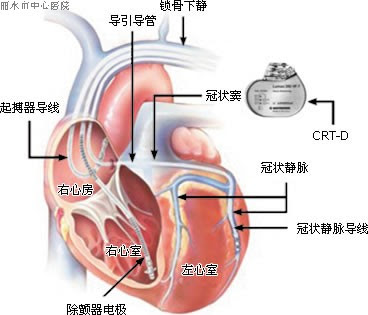 心脏再同步治疗