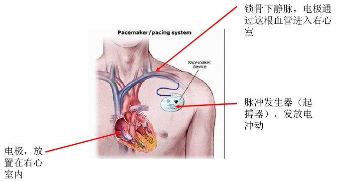经静脉起搏