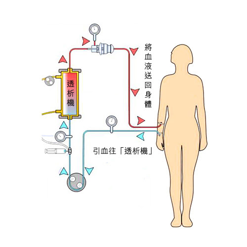 血液透析
