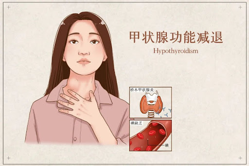 甲状腺功能减退症
