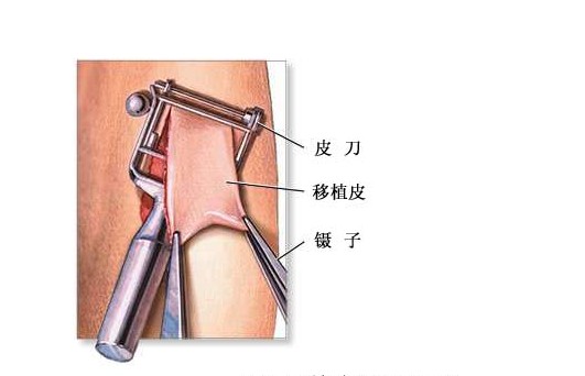皮肤移植