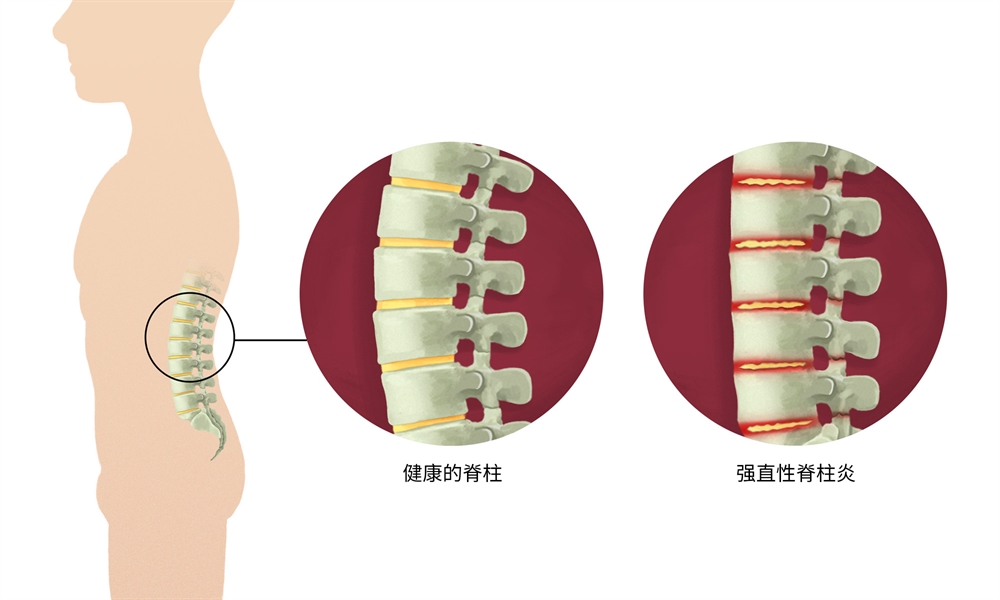强直性脊柱炎