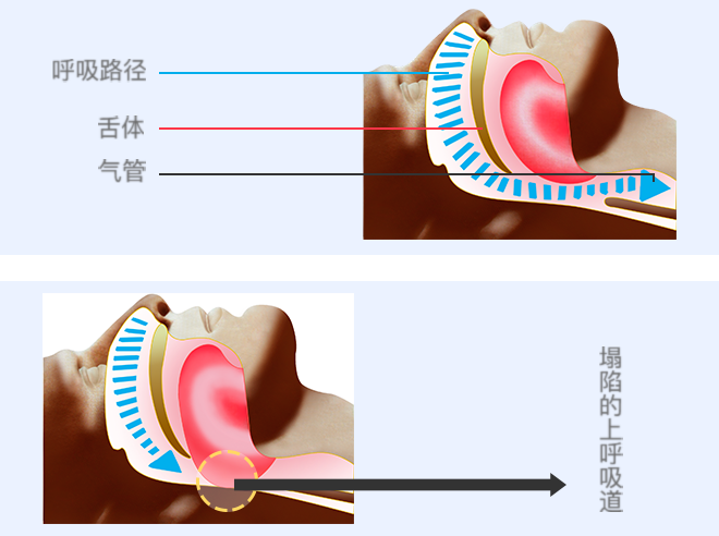 睡眠呼吸暂停