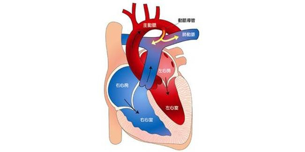 肺动脉高压