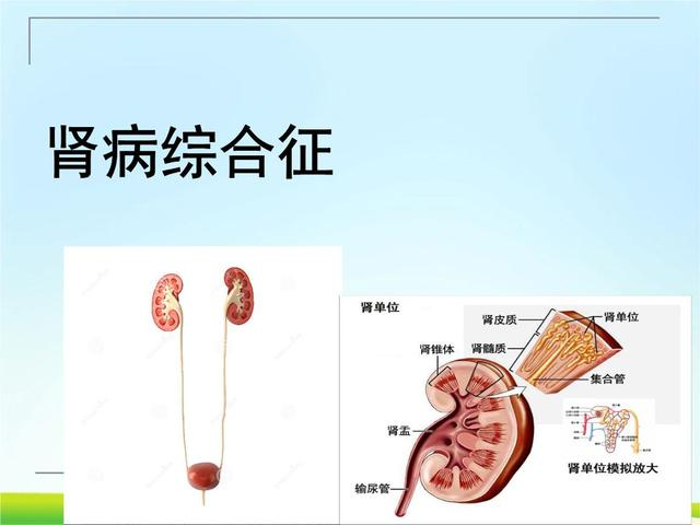 肾病综合征