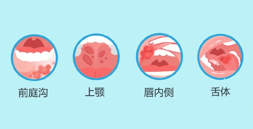 溃疡体
