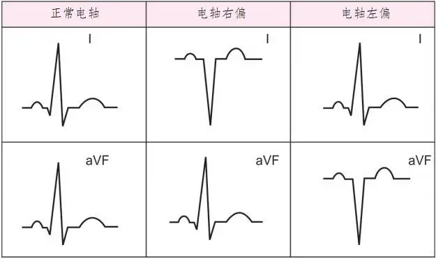 自动心电图解读