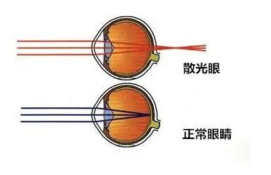 抑制(眼睛)