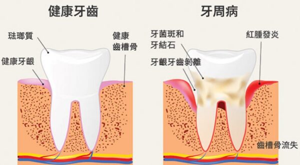 牙周疾病