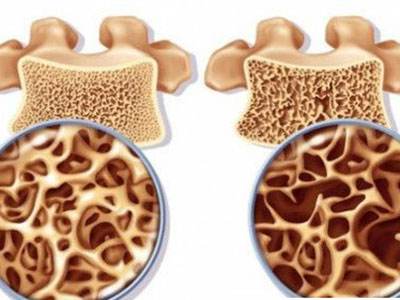 骨质疏松症